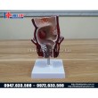 Mô hình hậu môn trực tràng bệnh lý